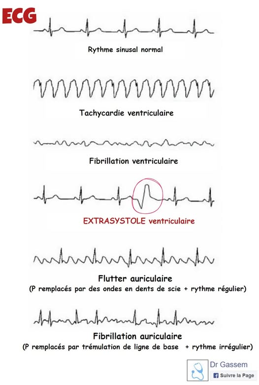 ECG ( FA   ESV   TV )